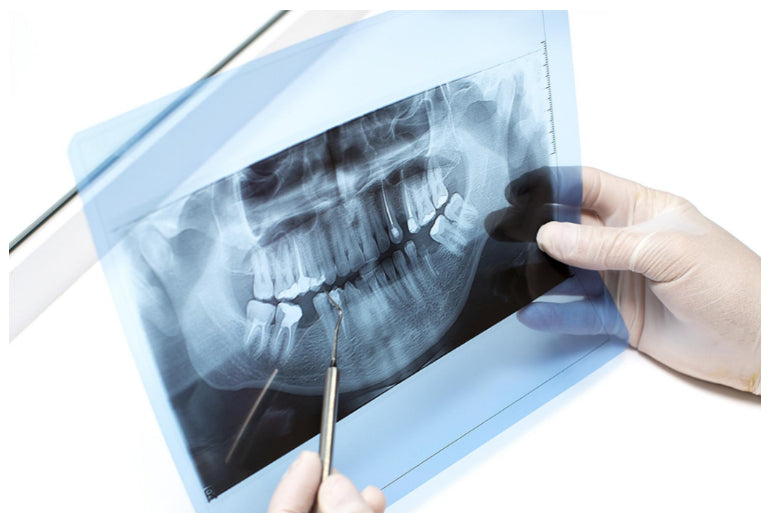 Zobni RTG je škodljiv. Pa vemo koliko dejansko škoduje zdravju telesa?
